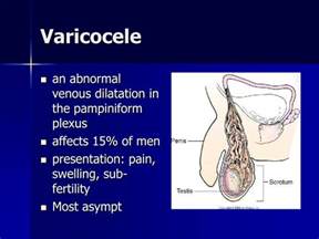 varice masculine din testicule